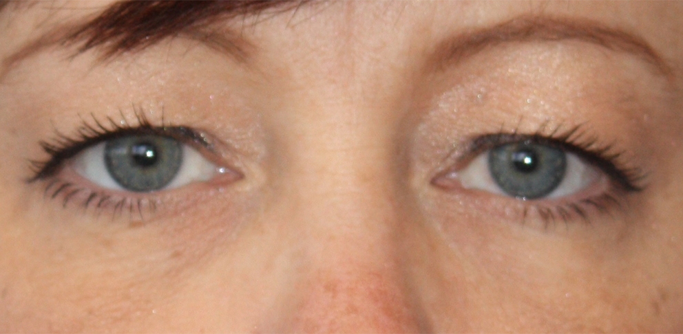 Patient 35 Before Image