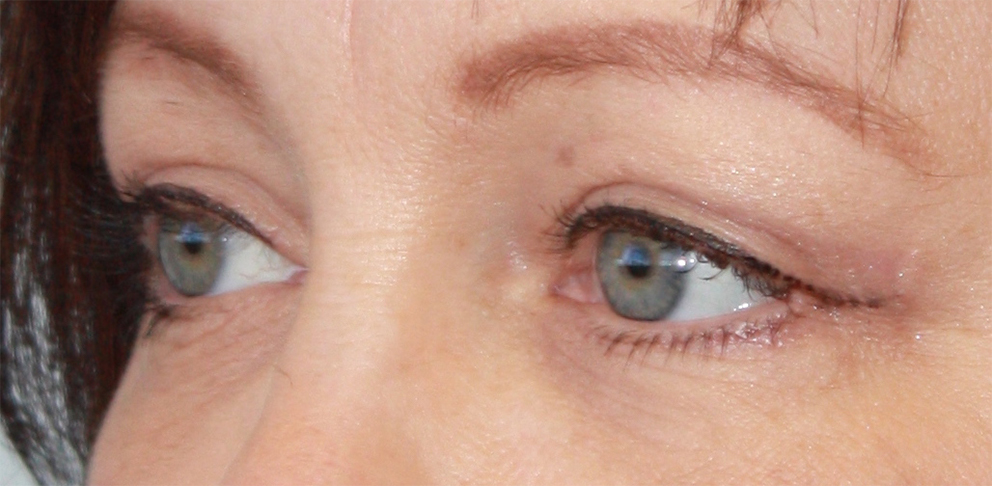 Patient 35 After Image