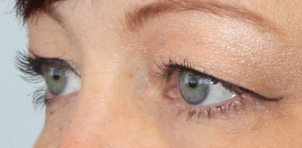 Patient 35 Before Image