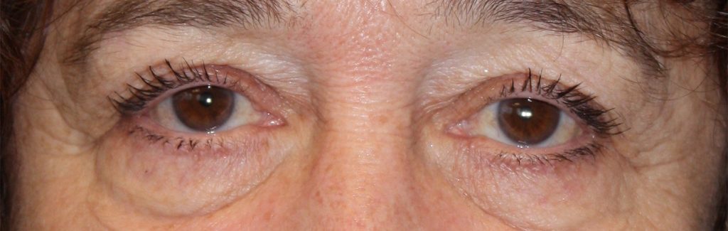 Patient 34 Before Image