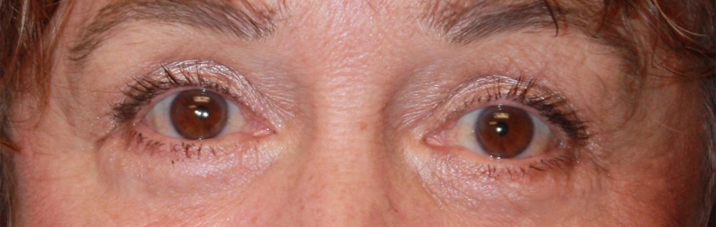 Patient 34 After Image