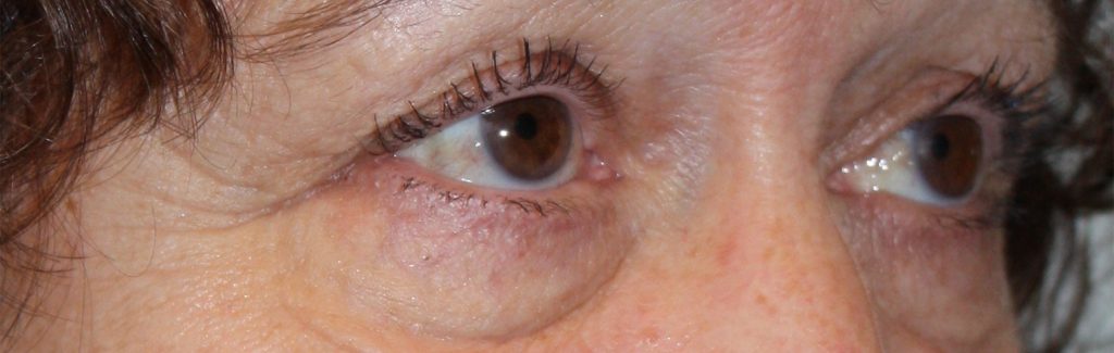 Patient 34 Before Image