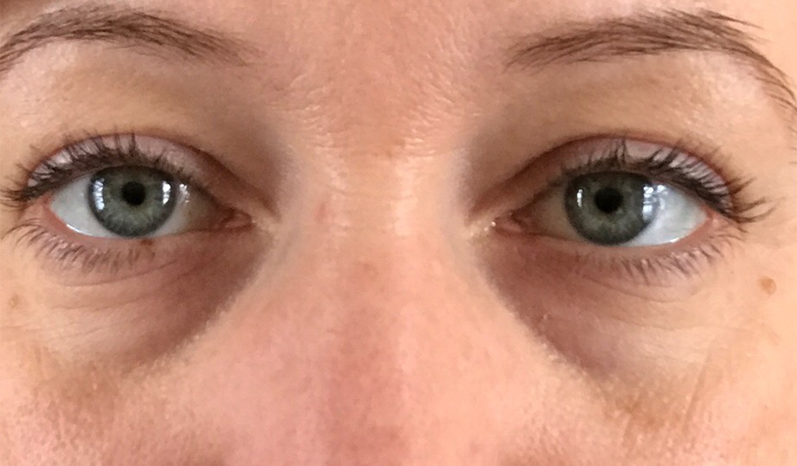 Patient 14 Before Image