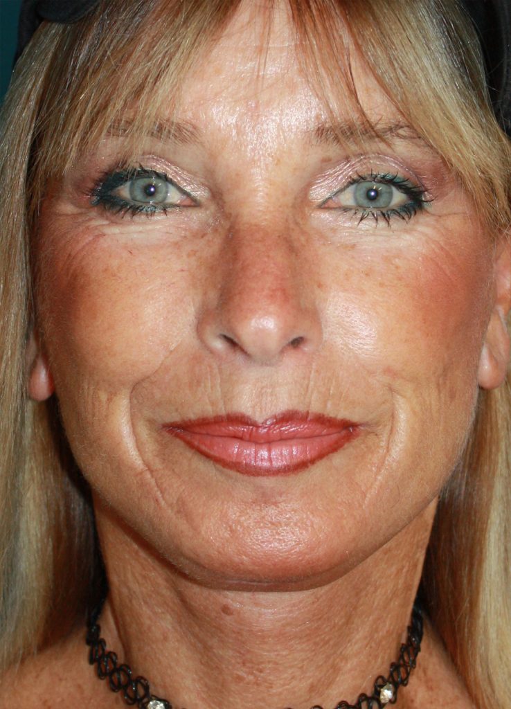 Patient 24 After Image