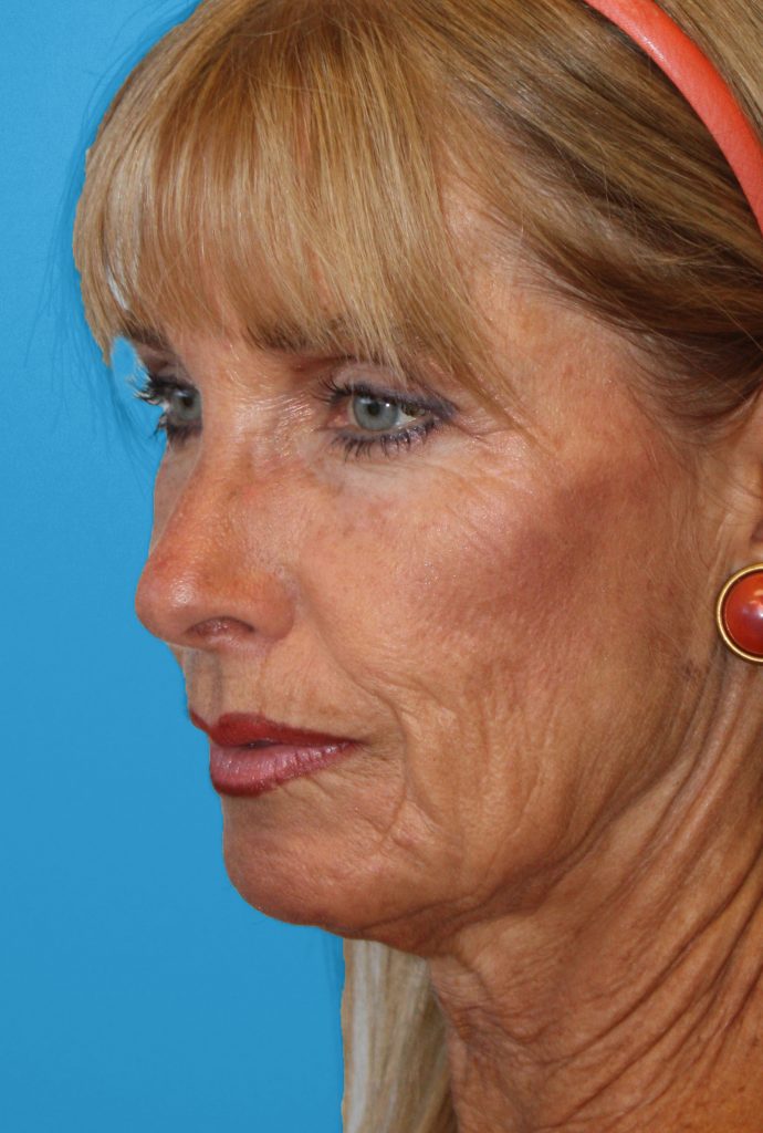 Patient 24 Before Image