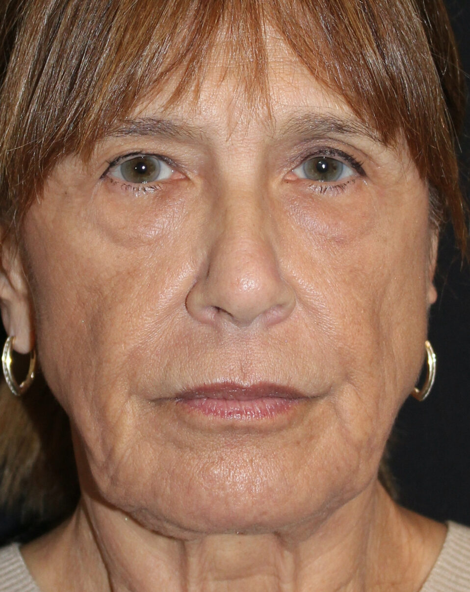 Patient #176 Before Image