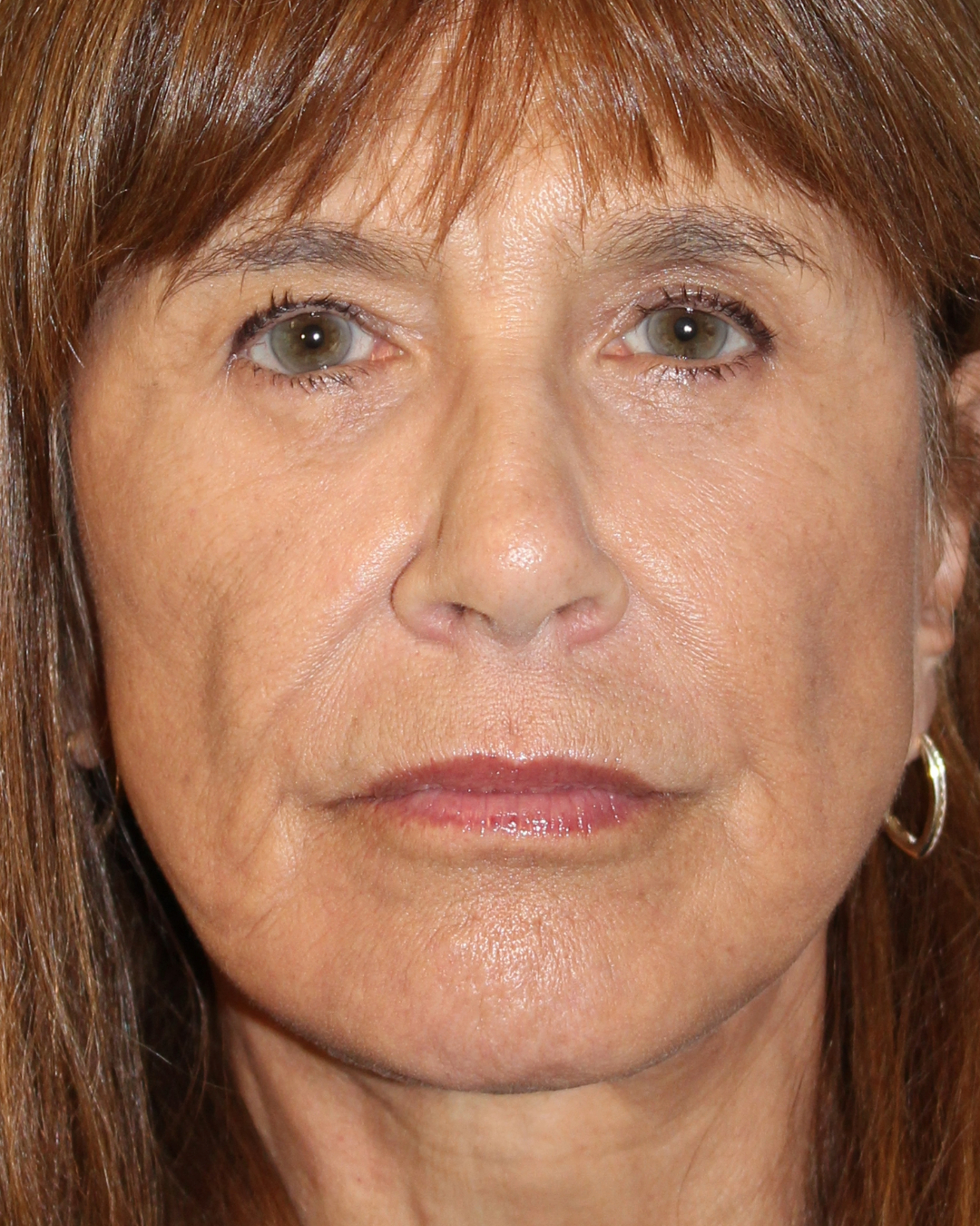 Patient #176 After Image