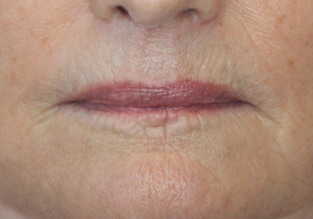 Patient 13 Before Image