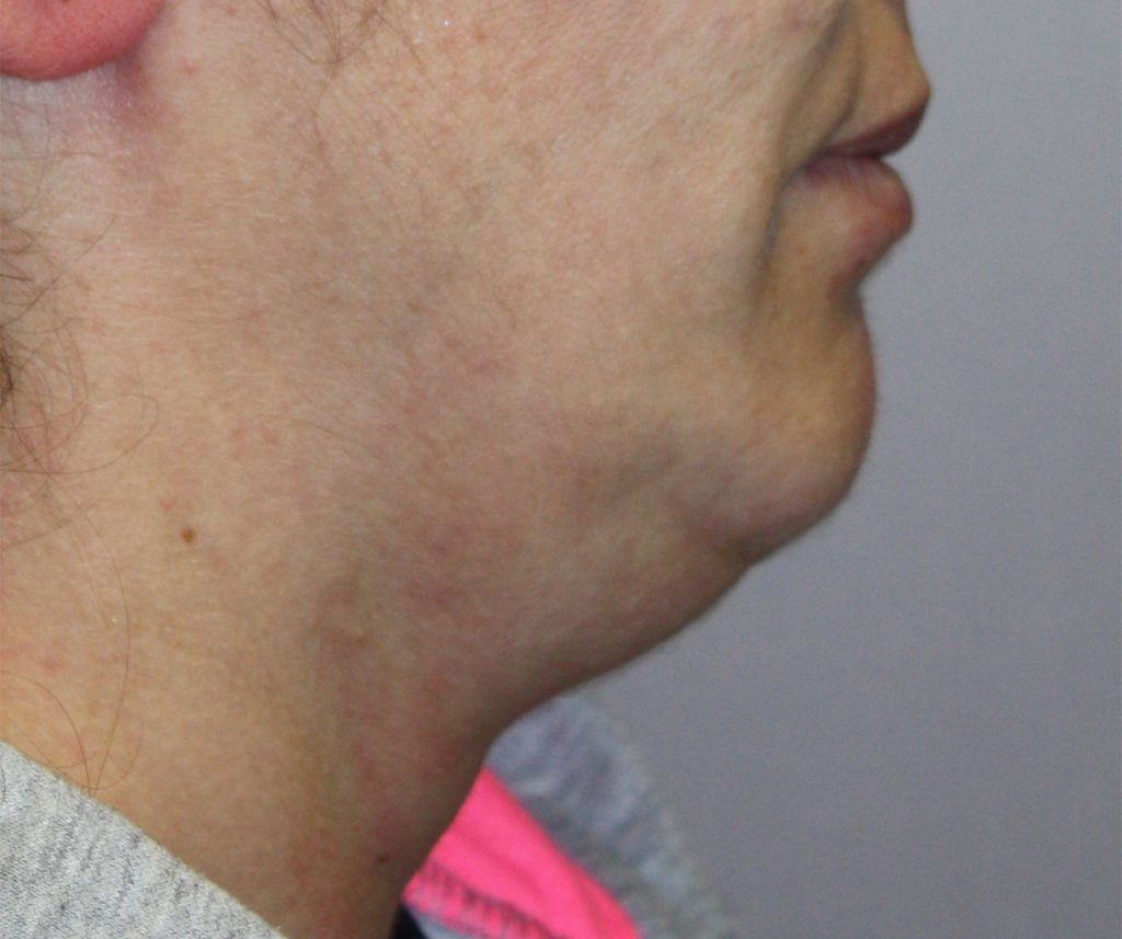 Patient 18 Before Image