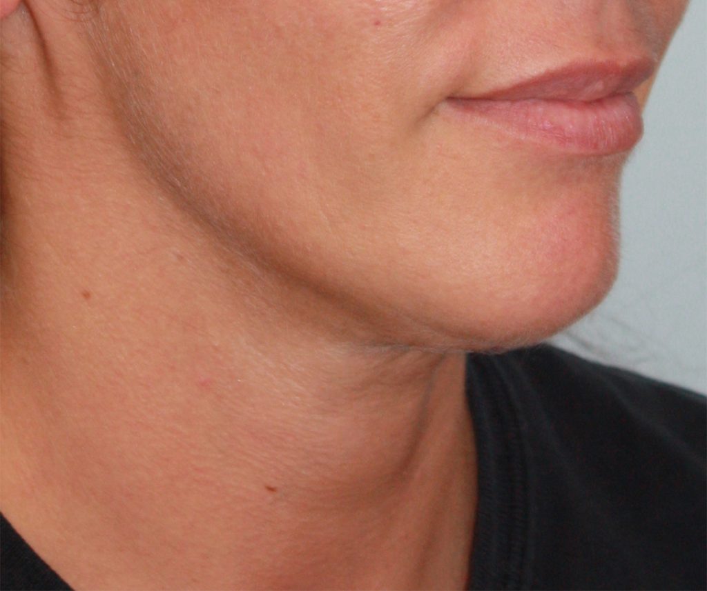 Patient 18 After Image