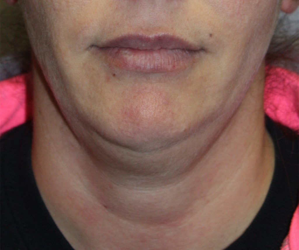 Patient 18 Before Image