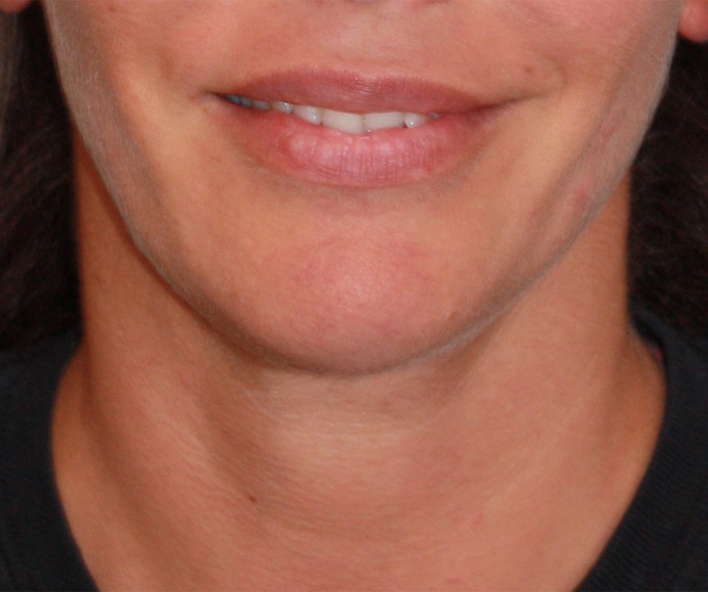 Patient 18 After Image