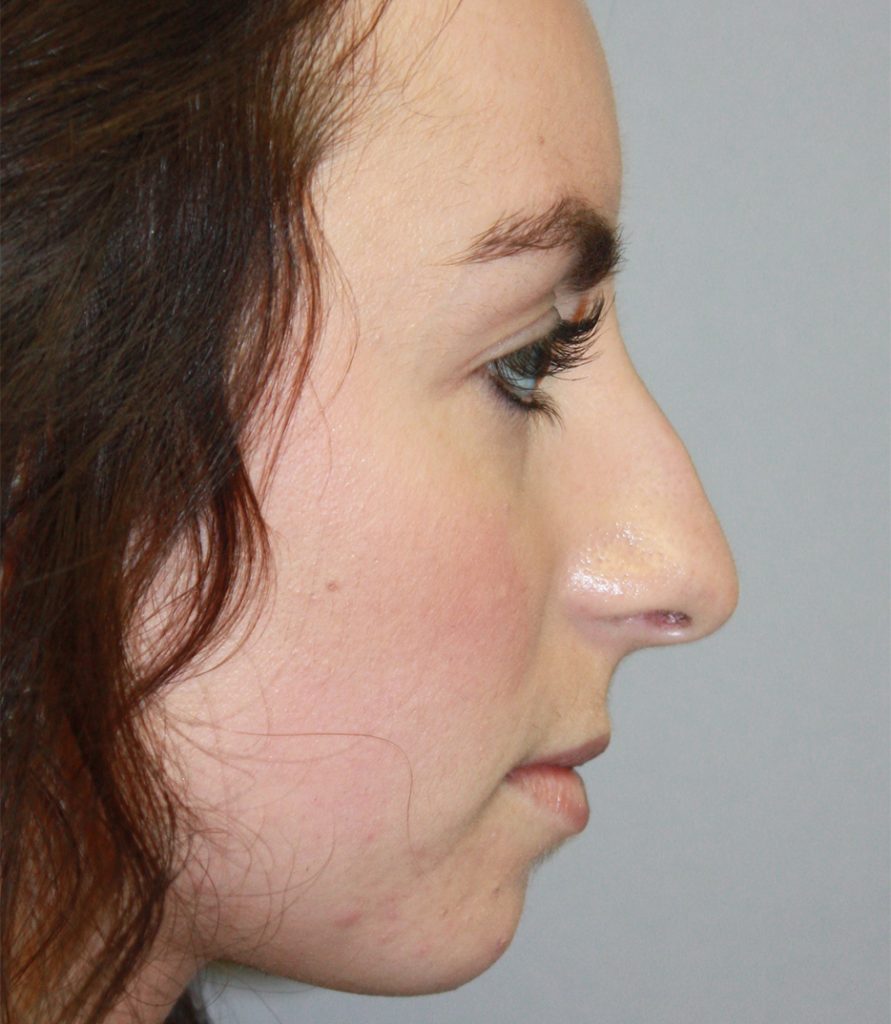 Patient 11 Before Image