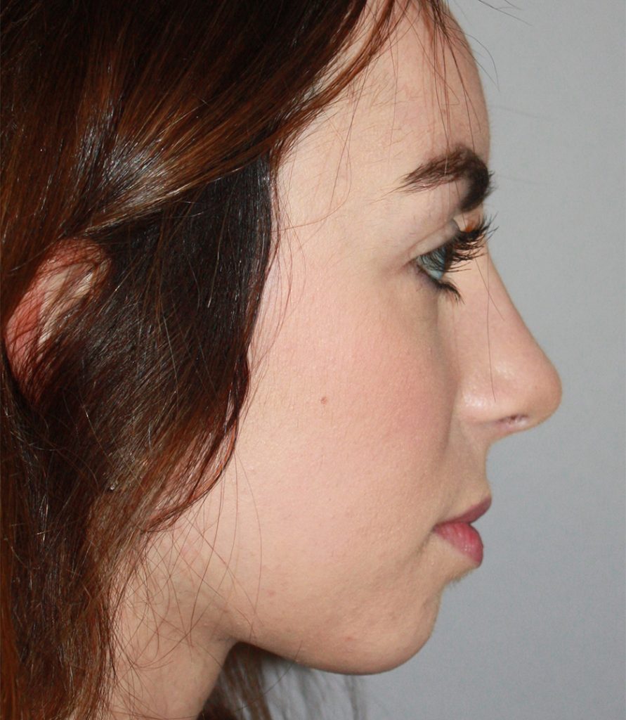 Patient 11 After Image