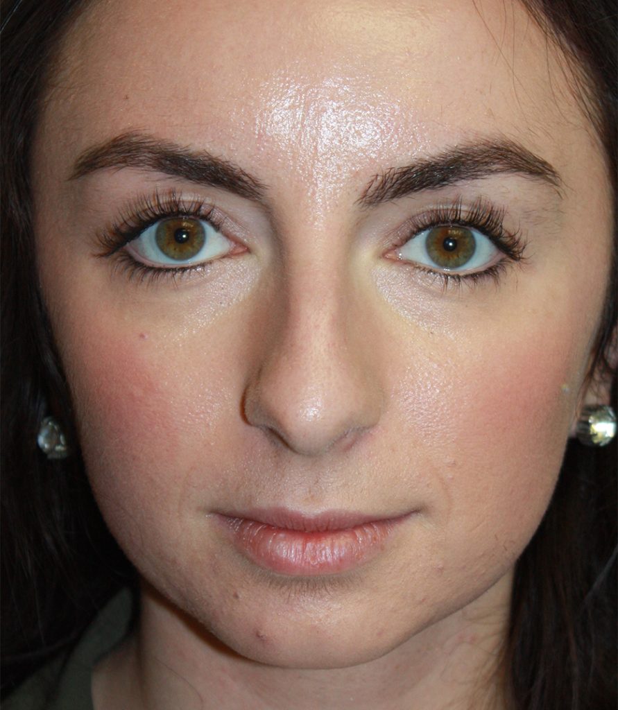 Patient 11 Before Image