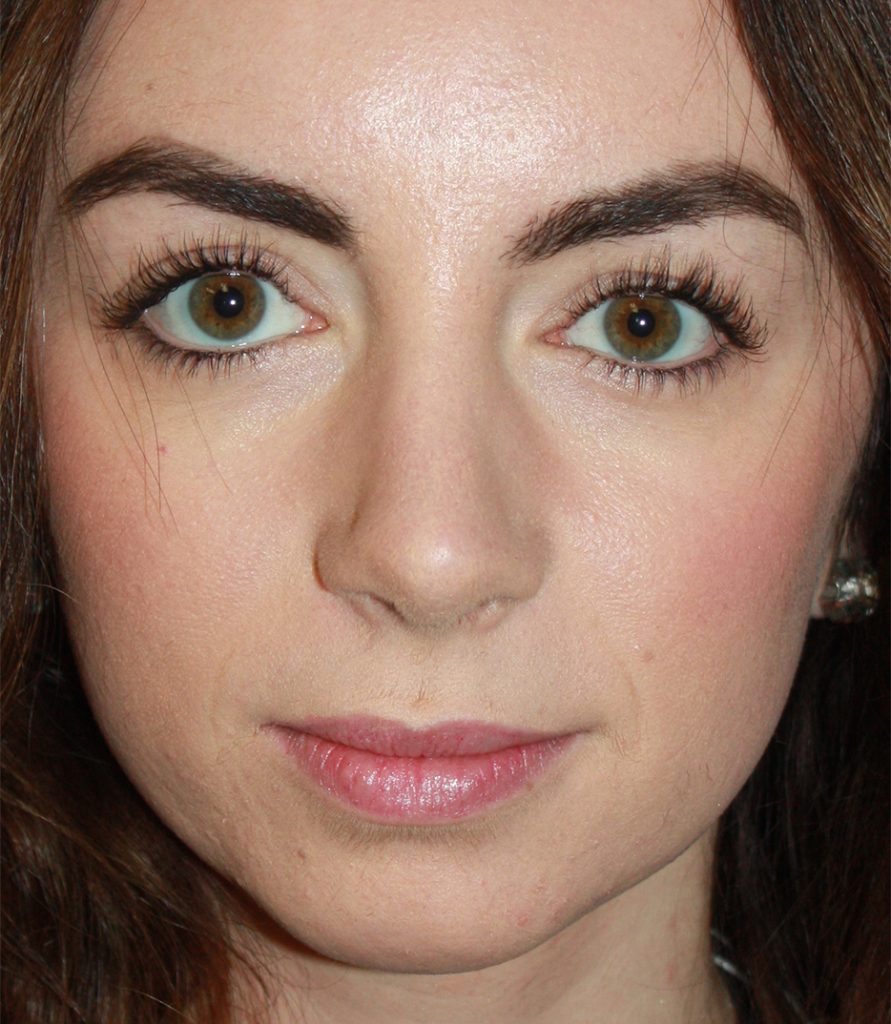 Patient 11 After Image