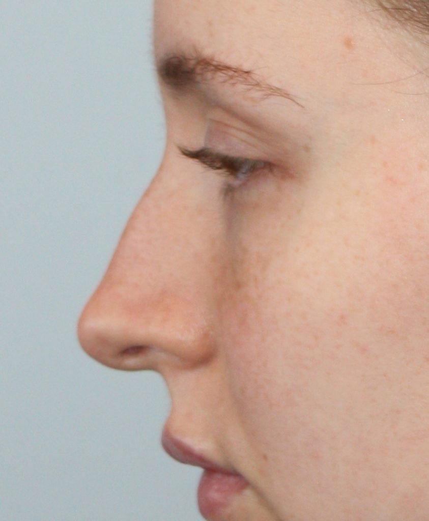 Patient 10 Before Image