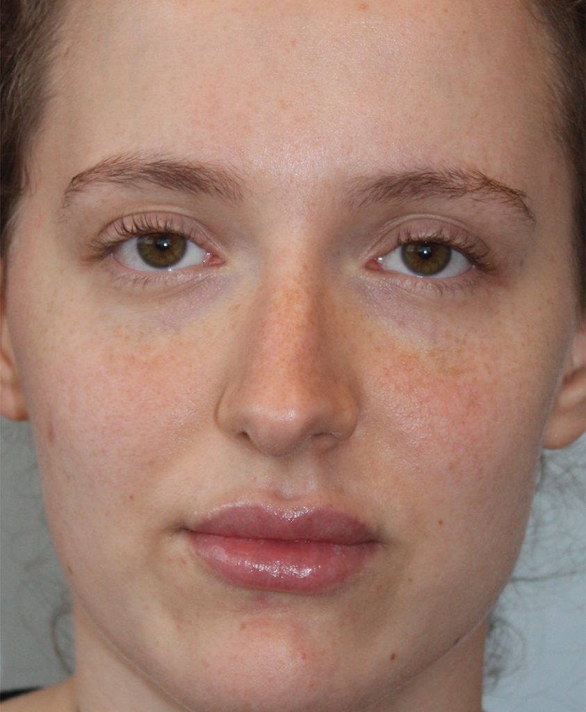 Patient 10 Before Image