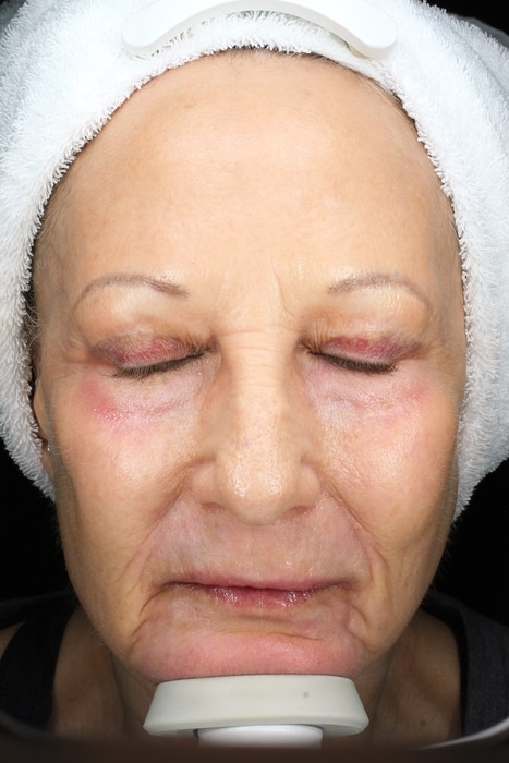 Patient 85 After Image