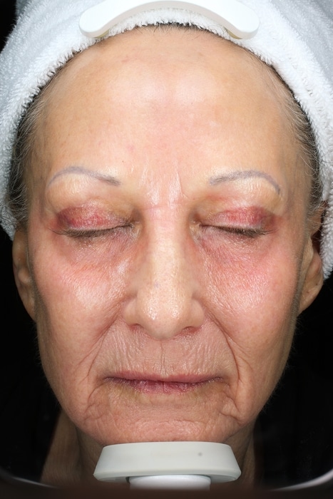 Patient 85 Before Image