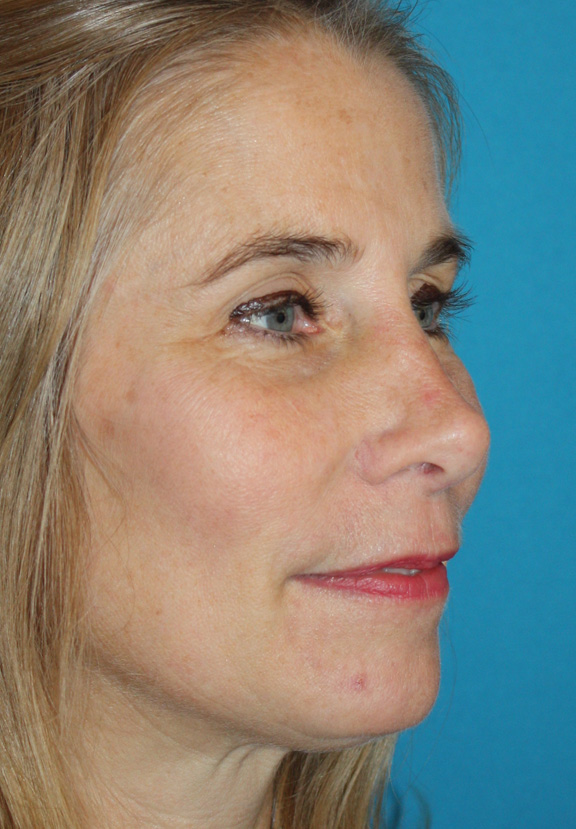 Patient 2 After Image