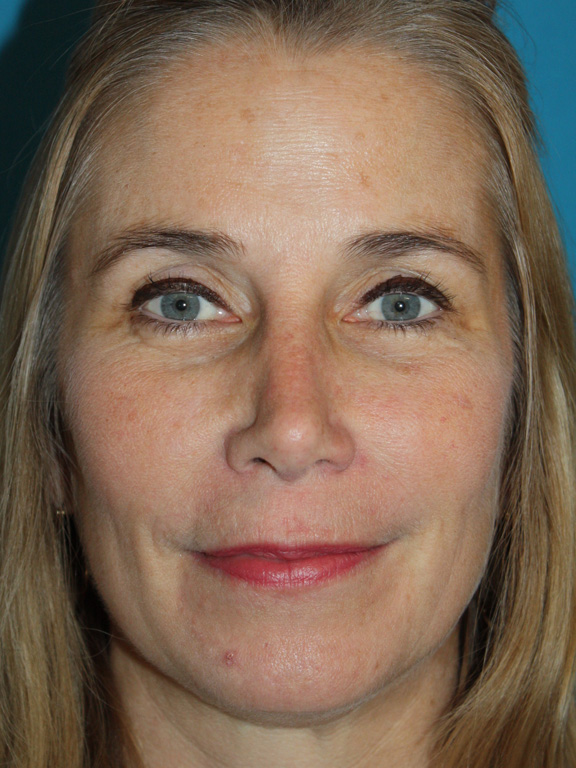 Patient 2 After Image