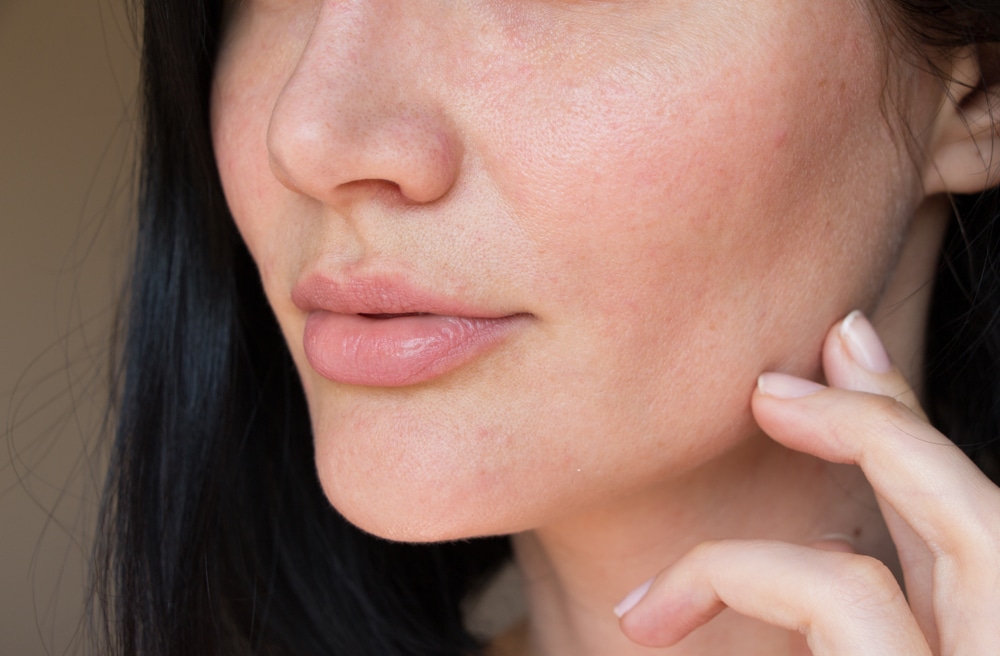 <strong> Why AviClear Is The Best Treatment For Adult Acne </strong> Image