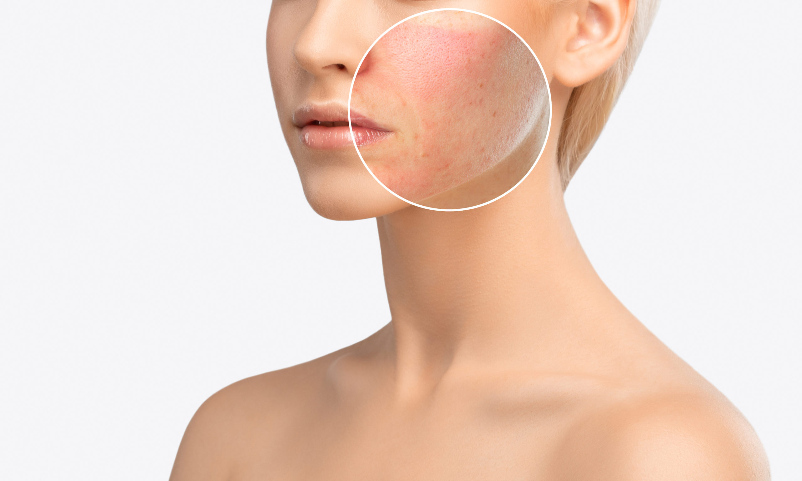 Treat Your Acne Scars with Morpheus8 Image