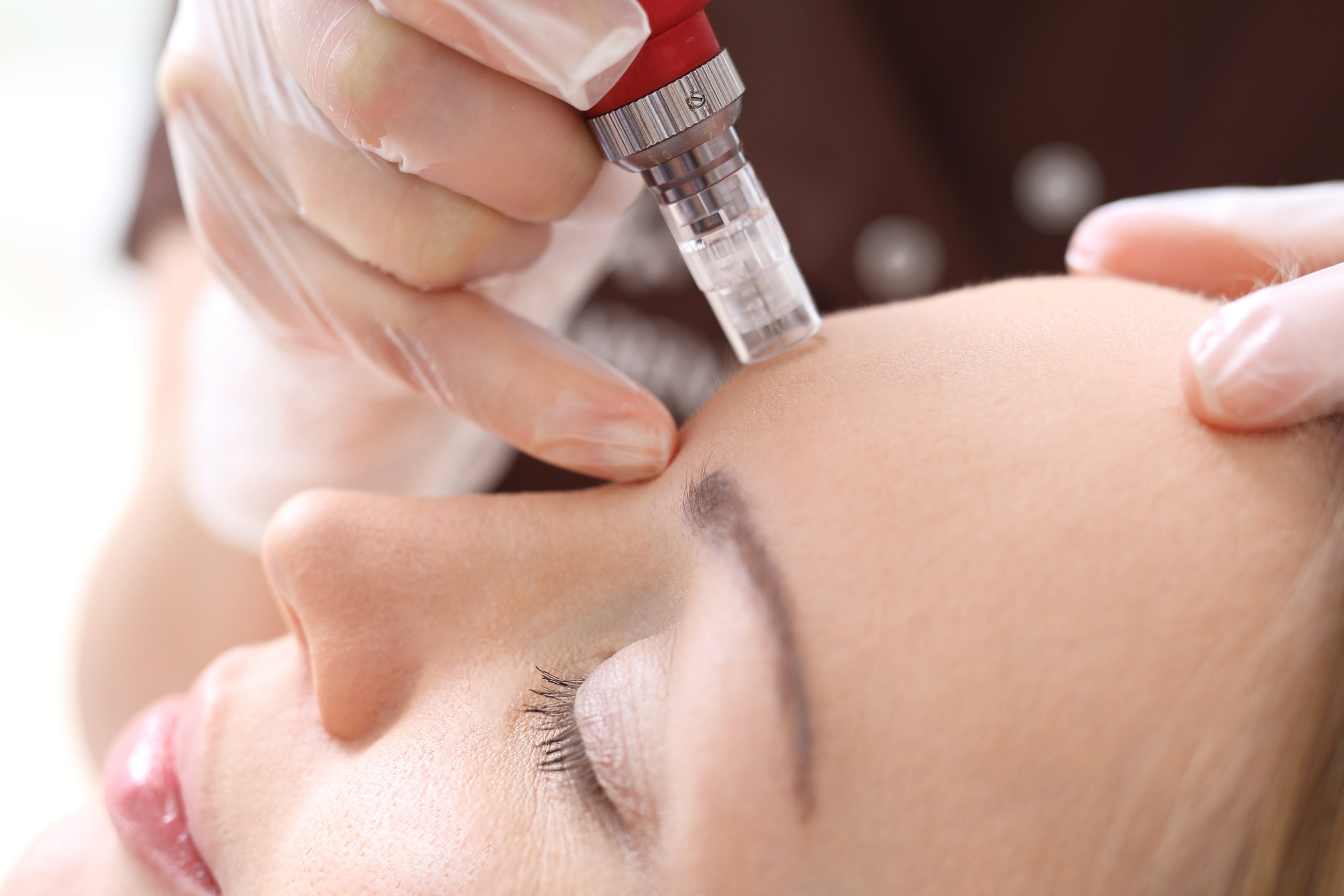 What is Microneedling? Image