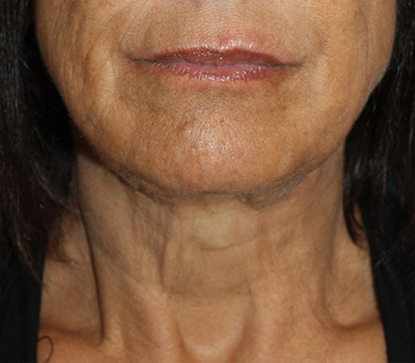 Patient 16 After Image