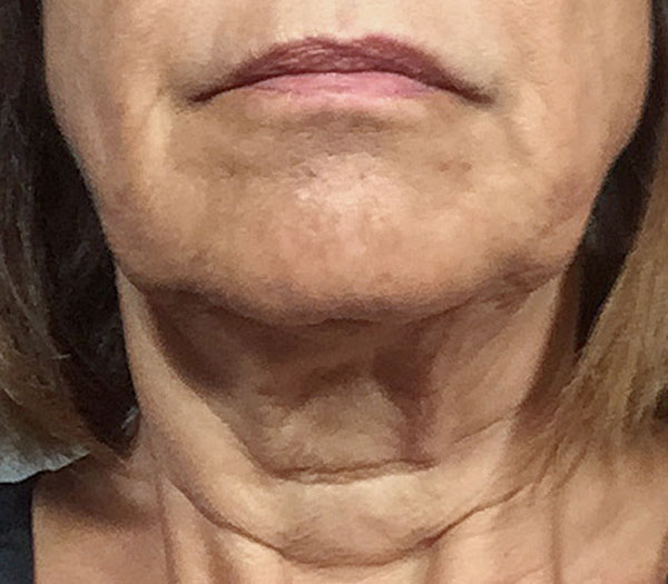 Patient 16 Before Image