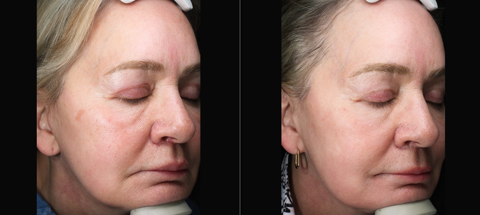 Patient #208 Marge Image