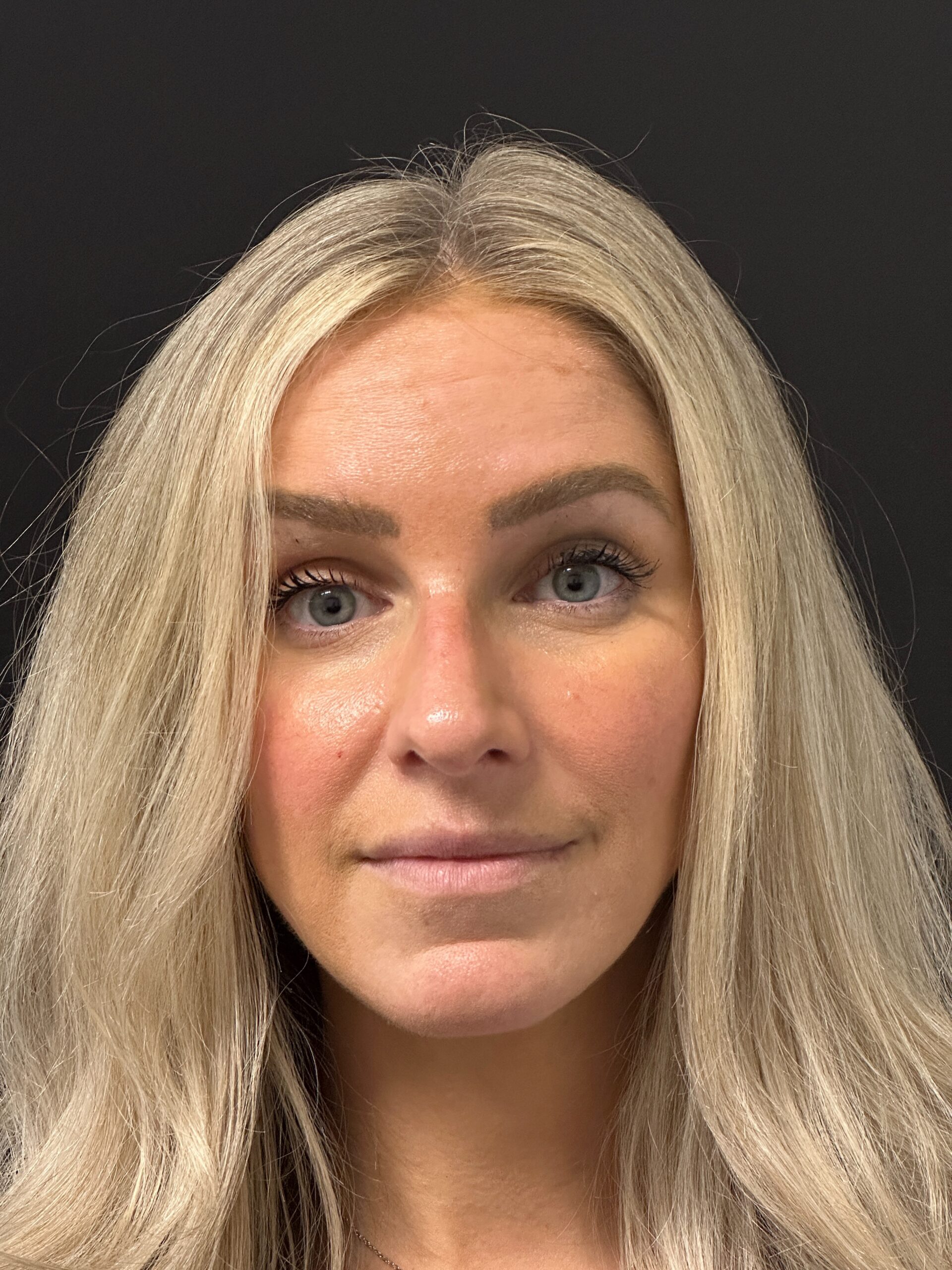 Patient #215 After Image