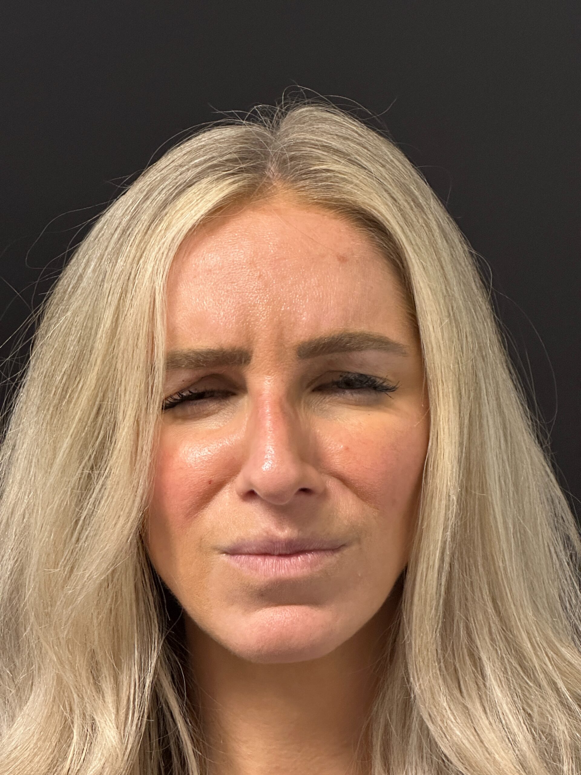 Patient #215 After Image
