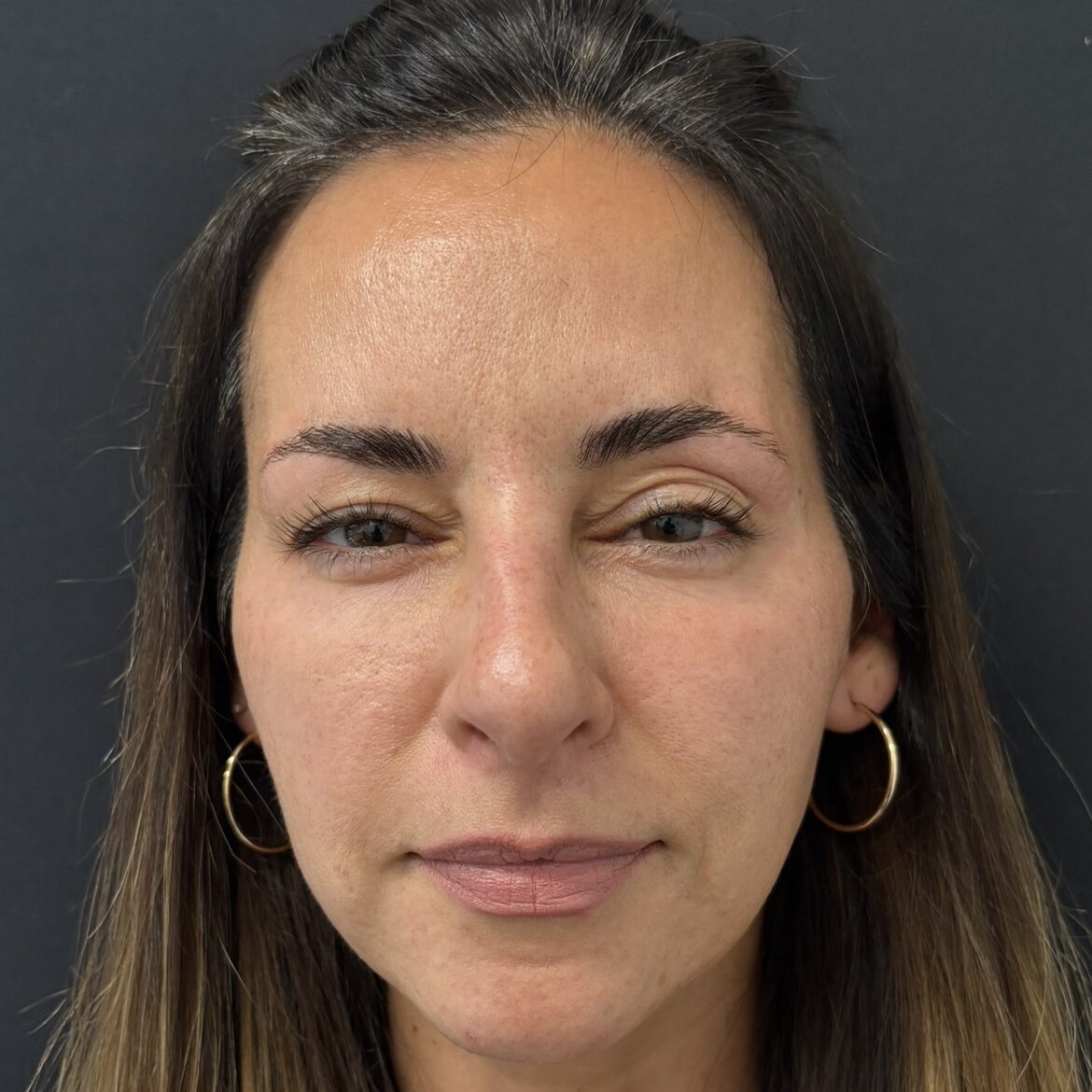 Patient #225 After Image